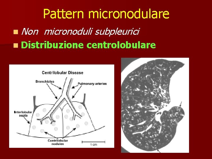 Pattern micronodulare n Non micronoduli subpleurici n Distribuzione centrolobulare 