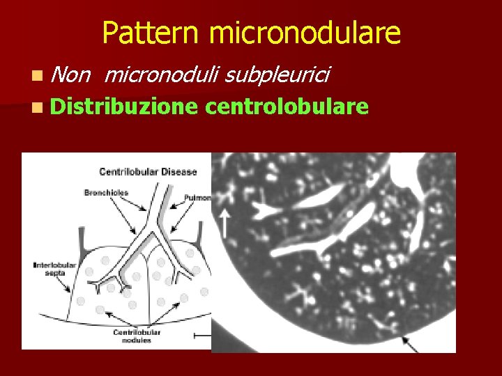 Pattern micronodulare n Non micronoduli subpleurici n Distribuzione centrolobulare 