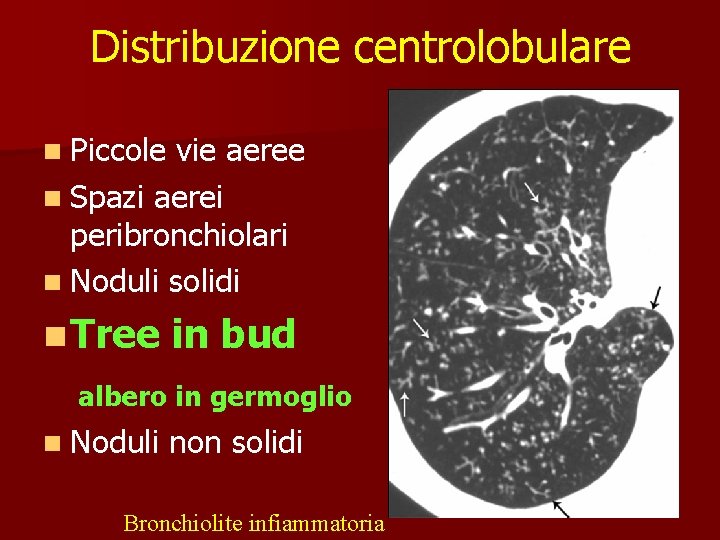 Distribuzione centrolobulare n Piccole vie aeree n Spazi aerei peribronchiolari n Noduli solidi n