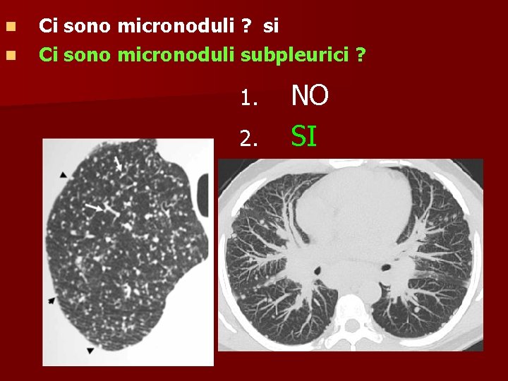 n n Ci sono micronoduli ? si Ci sono micronoduli subpleurici ? 1. 2.