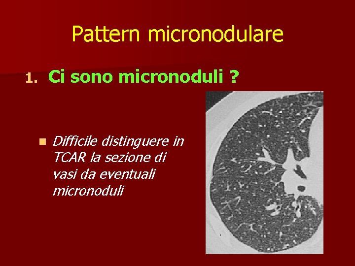 Pattern micronodulare 1. n Ci sono micronoduli ? Difficile distinguere in TCAR la sezione