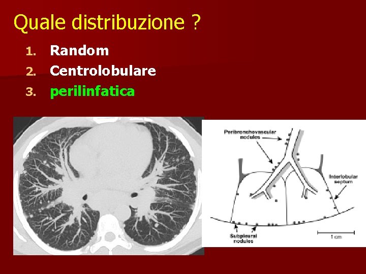 Quale distribuzione ? Random 2. Centrolobulare 3. perilinfatica 1. 