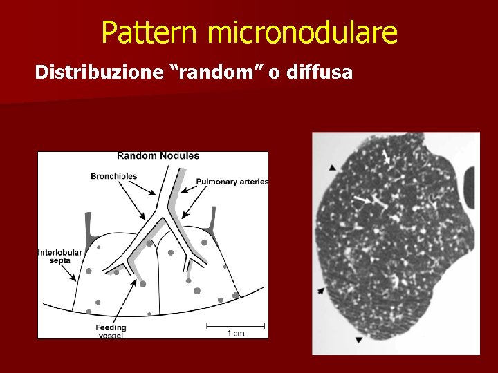 Pattern micronodulare Distribuzione “random” o diffusa 