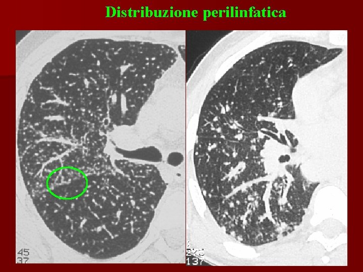 Distribuzione perilinfatica 