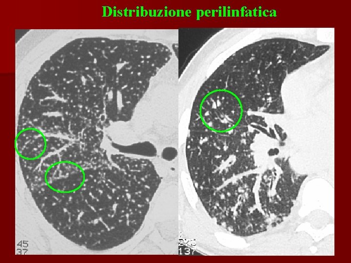 Distribuzione perilinfatica 