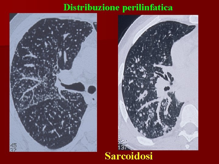 Distribuzione perilinfatica Sarcoidosi 