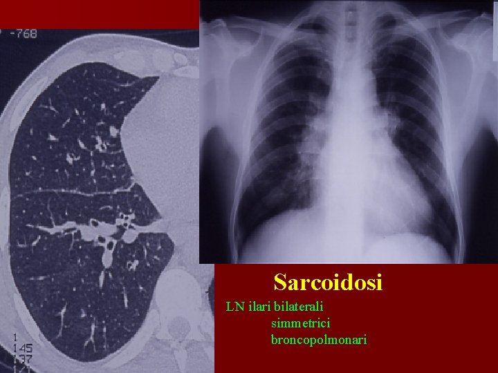 Sarcoidosi LN ilari bilaterali simmetrici broncopolmonari 