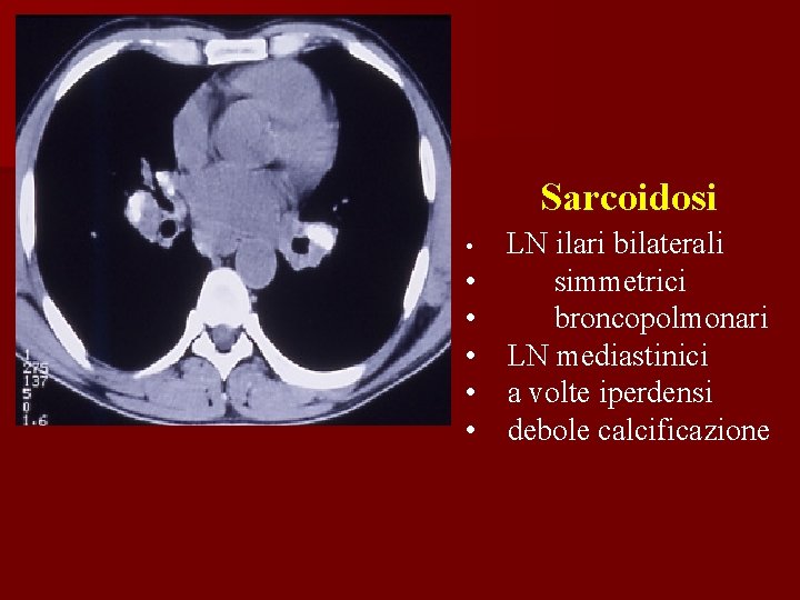 Sarcoidosi • • • LN ilari bilaterali simmetrici broncopolmonari LN mediastinici a volte iperdensi