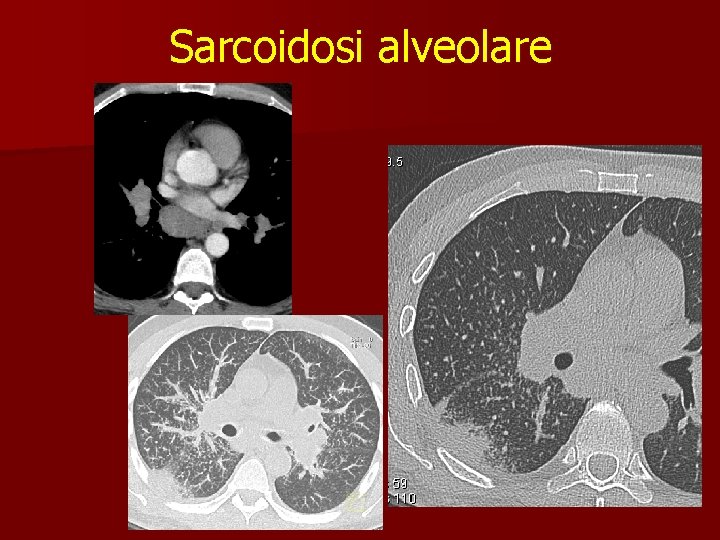 Sarcoidosi alveolare 