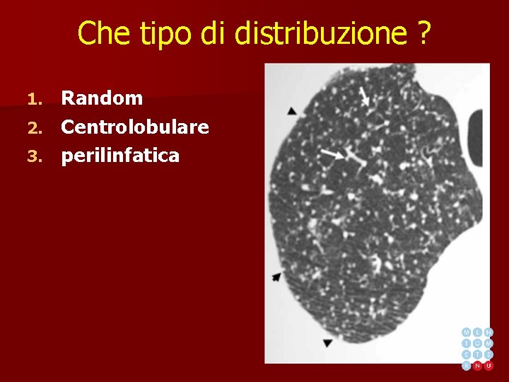 Che tipo di distribuzione ? Random 2. Centrolobulare 3. perilinfatica 1. 