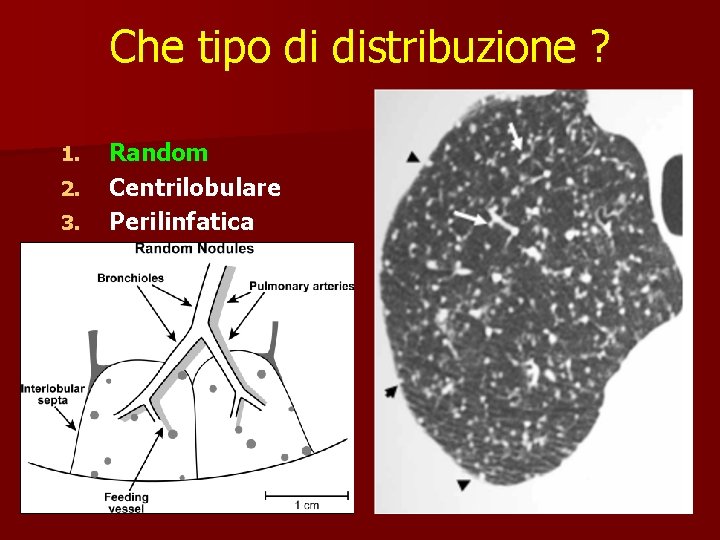 Che tipo di distribuzione ? 1. 2. 3. Random Centrilobulare Perilinfatica 