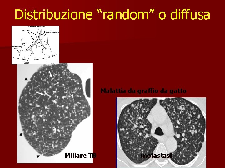 Distribuzione “random” o diffusa Malattia da graffio da gatto Miliare TB metastasi 