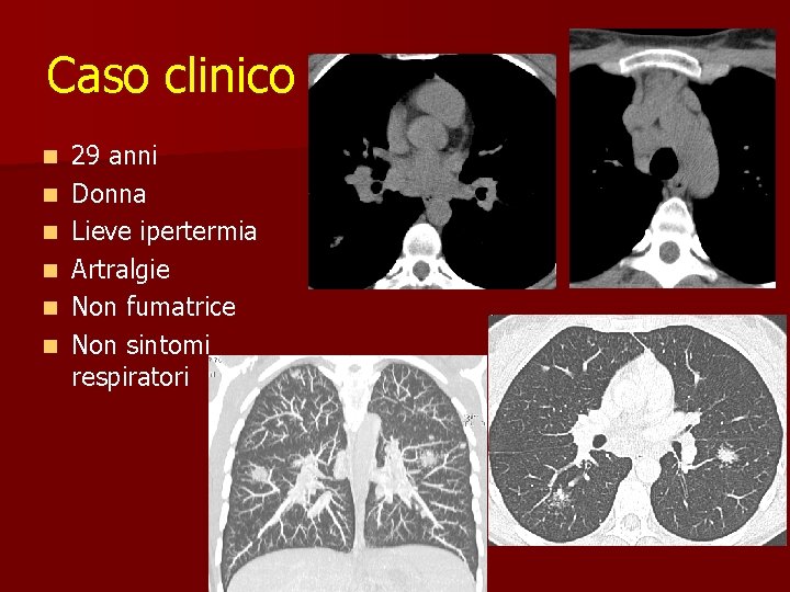 Caso clinico n n n 29 anni Donna Lieve ipertermia Artralgie Non fumatrice Non