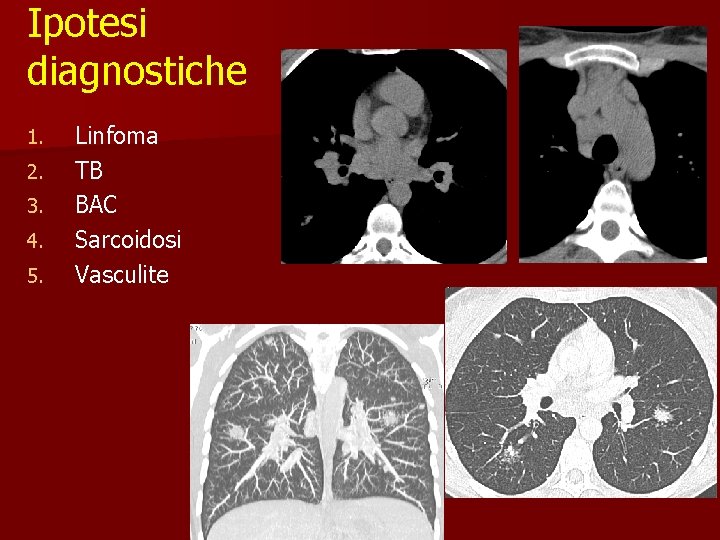 Ipotesi diagnostiche 1. 2. 3. 4. 5. Linfoma TB BAC Sarcoidosi Vasculite 