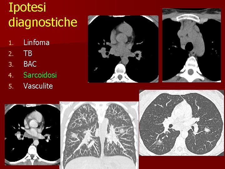 Ipotesi diagnostiche 1. 2. 3. 4. 5. Linfoma TB BAC Sarcoidosi Vasculite 