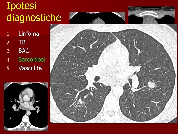 Ipotesi diagnostiche 1. 2. 3. 4. 5. Linfoma TB BAC Sarcoidosi Vasculite 