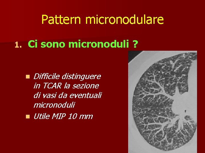 Pattern micronodulare 1. Ci sono micronoduli ? n n Difficile distinguere in TCAR la