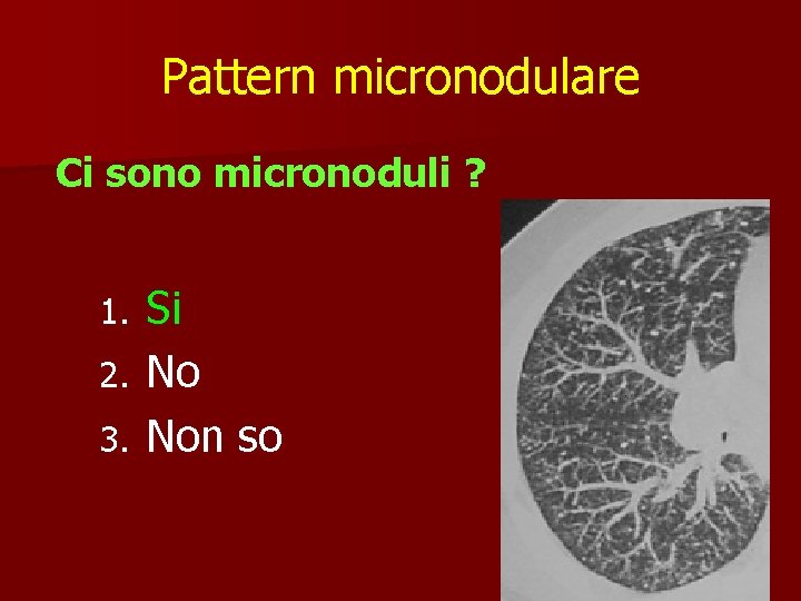 Pattern micronodulare Ci sono micronoduli ? Si 2. No 3. Non so 1. 