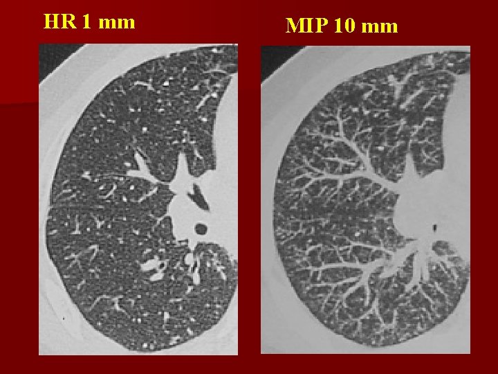 HR 1 mm MIP 10 mm 