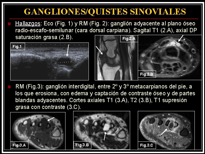 GANGLIONESQUISTES SINOVIALES Etiologa Ganglin Q Sinovial Histologa ganglionesquistes-sinoviales-etiologa-ganglin-q-sinovial-histologa