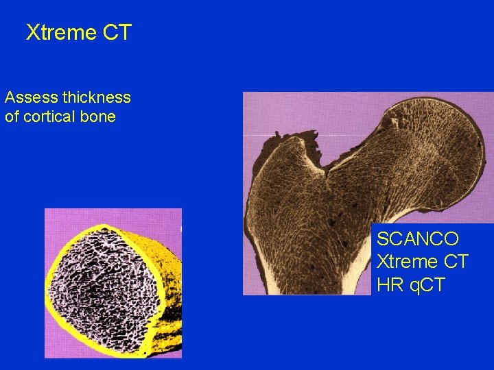 Xtreme CT Assess thickness of cortical bone SCANCO Xtreme CT HR q. CT 
