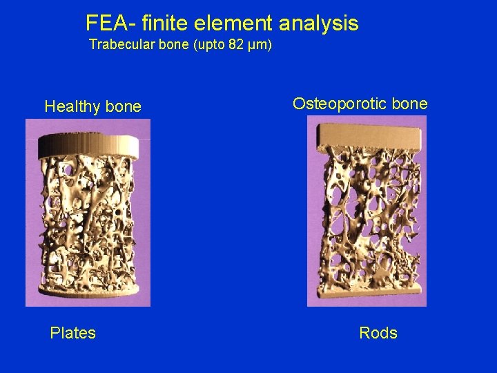 FEA- finite element analysis Trabecular bone (upto 82 µm) Healthy bone Plates Osteoporotic bone