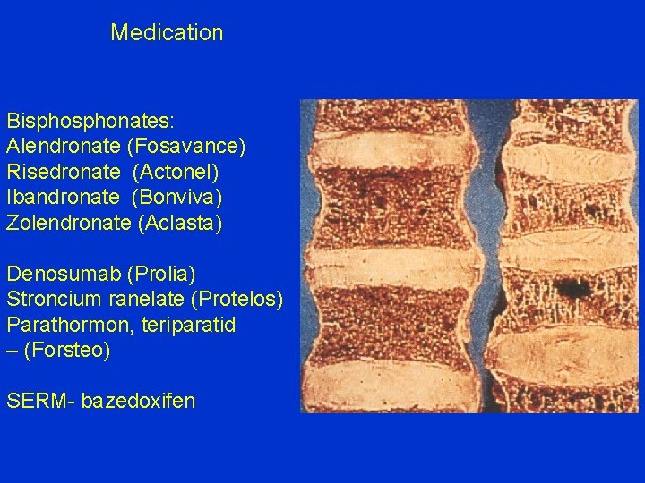 Medication Bisphonates: Alendronate (Fosavance) Risedronate (Actonel) Ibandronate (Bonviva) Zolendronate (Aclasta) Denosumab (Prolia) Stroncium ranelate