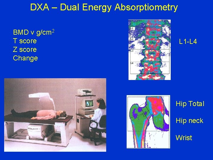 DXA – Dual Energy Absorptiometry BMD v g/cm 2 T score Z score Change