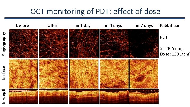 OCT monitoring of PDT: effect of dose before after in 1 day in 4