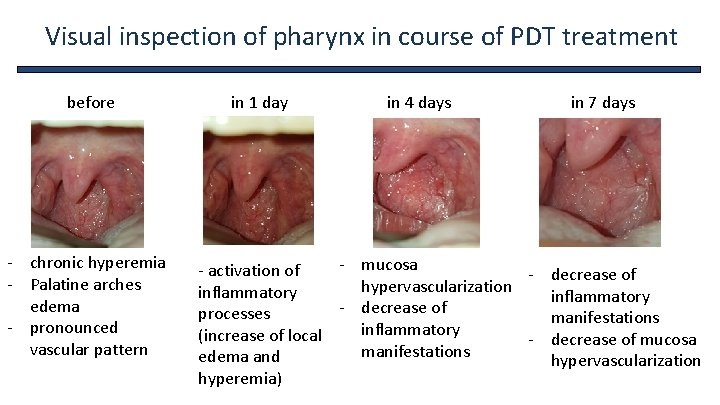 Visual inspection of pharynx in course of PDT treatment before - chronic hyperemia -