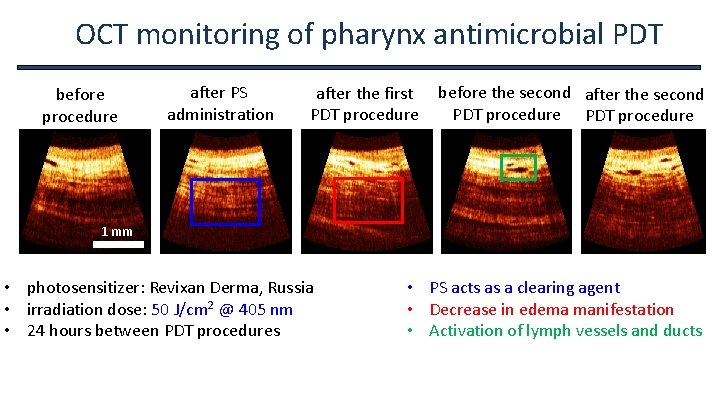 OCT monitoring of pharynx antimicrobial PDT before procedure after PS administration after the first