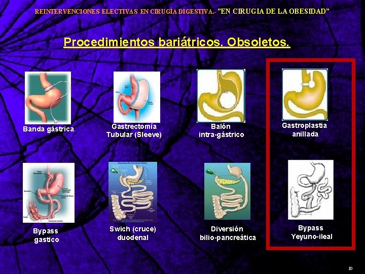 REINTERVENCIONES ELECTIVAS EN CIRUGÍA DIGESTIVA. - ”EN CIRUGIA DE LA OBESIDAD” Procedimientos bariátricos. Obsoletos.