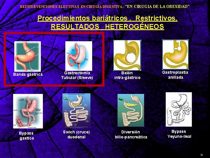 REINTERVENCIONES ELECTIVAS EN CIRUGÍA DIGESTIVA. - ”EN CIRUGIA DE LA OBESIDAD” Procedimientos bariátricos. Restrictivos.