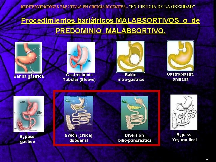 REINTERVENCIONES ELECTIVAS EN CIRUGÍA DIGESTIVA. - ”EN CIRUGIA DE LA OBESIDAD” Procedimientos bariátricos MALABSORTIVOS