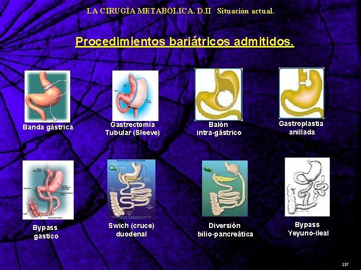 LA CIRUGÍA METABÓLICA. D. II Situación actual. Procedimientos bariátricos admitidos. Banda gástrica Bypass gastico