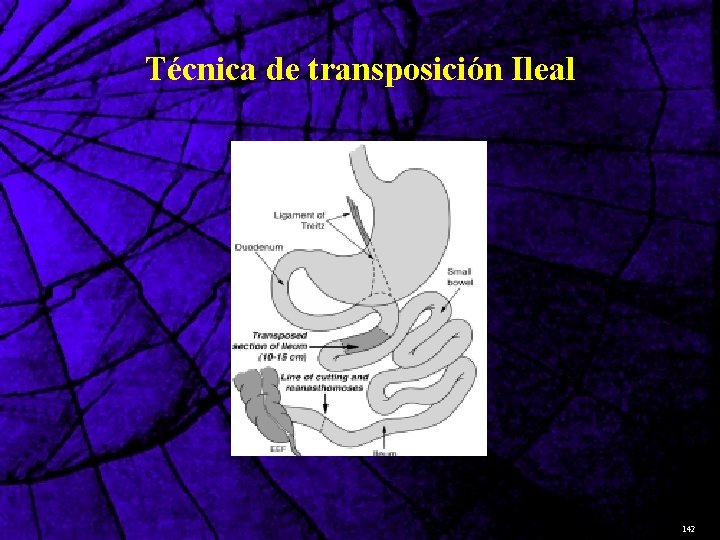  Técnica de transposición Ileal 142 