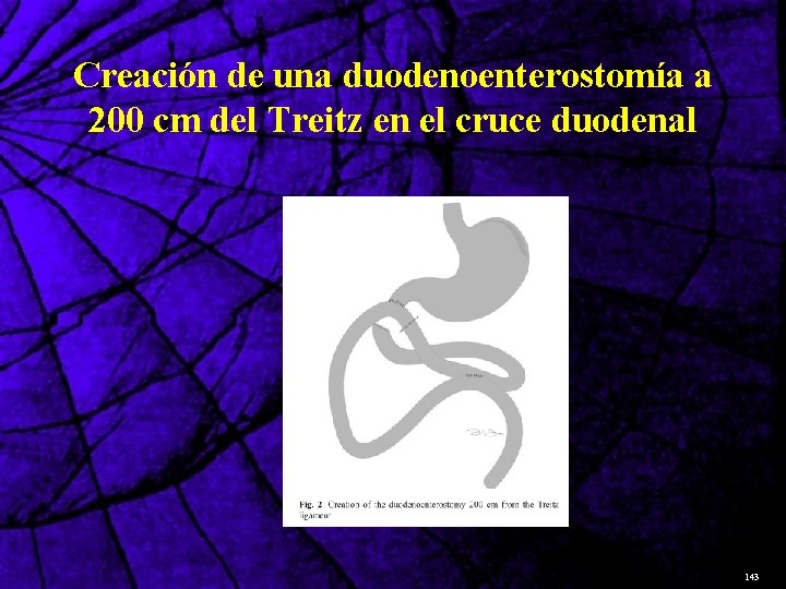 Creación de una duodenoenterostomía a 200 cm del Treitz en el cruce duodenal 143