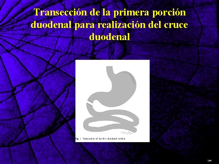 Transección de la primera porción duodenal para realización del cruce duodenal 144 