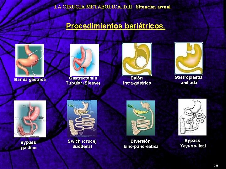 LA CIRUGÍA METABÓLICA. D. II Situación actual. Procedimientos bariátricos. Banda gástrica Bypass gastico Gastrectomía