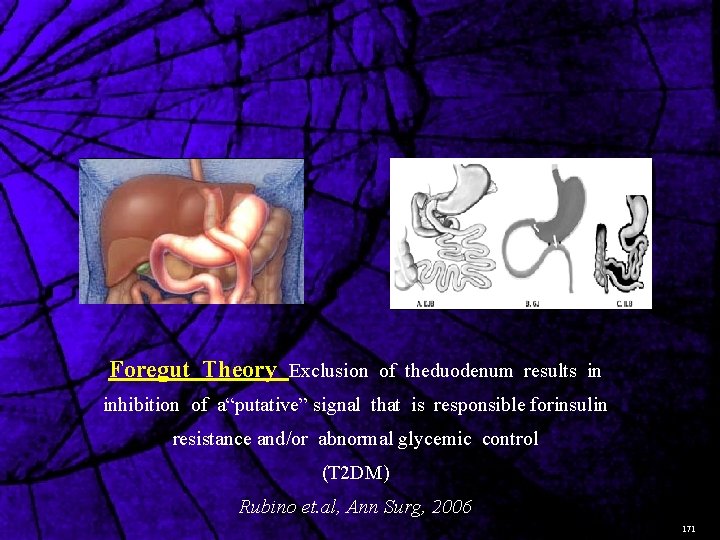 Foregut Theory Exclusion of theduodenum results in inhibition of a“putative” signal that is responsible