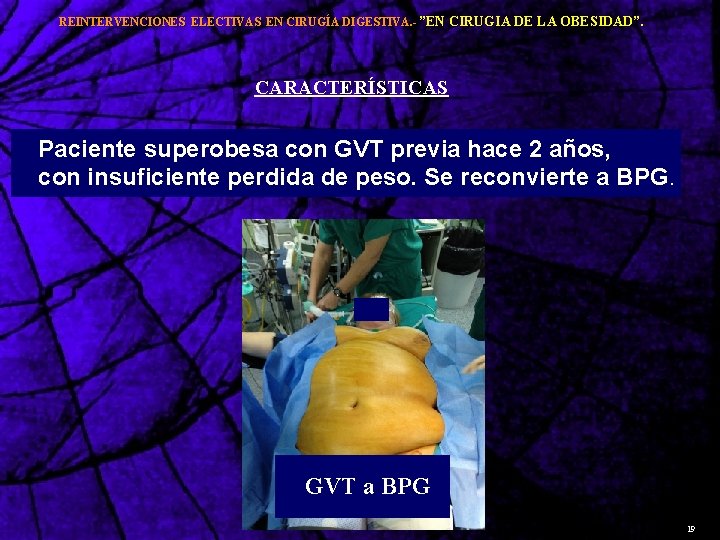 REINTERVENCIONES ELECTIVAS EN CIRUGÍA DIGESTIVA. - ”EN CIRUGIA DE LA OBESIDAD”. CARACTERÍSTICAS Paciente superobesa