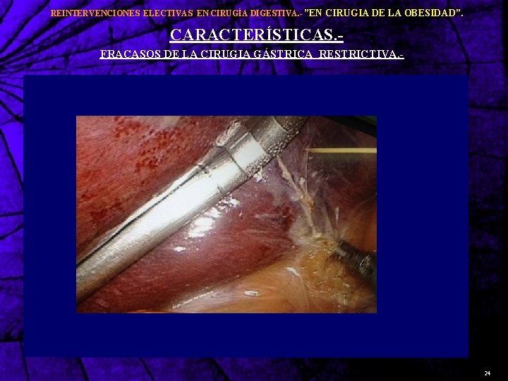 REINTERVENCIONES ELECTIVAS EN CIRUGÍA DIGESTIVA. - ”EN CIRUGIA DE LA OBESIDAD”. CARACTERÍSTICAS. - FRACASOS