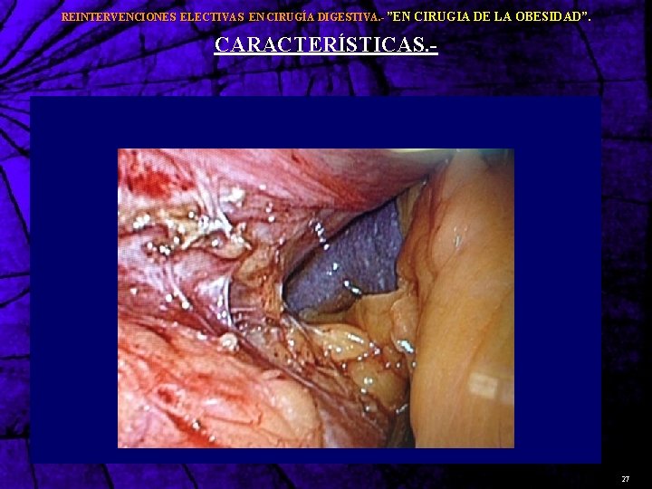 REINTERVENCIONES ELECTIVAS EN CIRUGÍA DIGESTIVA. - ”EN CIRUGIA DE LA OBESIDAD”. CARACTERÍSTICAS. - 27