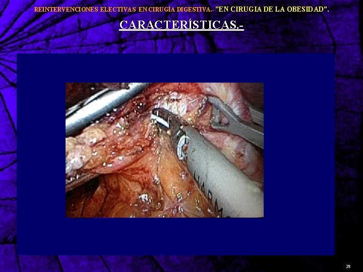 REINTERVENCIONES ELECTIVAS EN CIRUGÍA DIGESTIVA. - ”EN CIRUGIA DE LA OBESIDAD”. CARACTERÍSTICAS. - 28