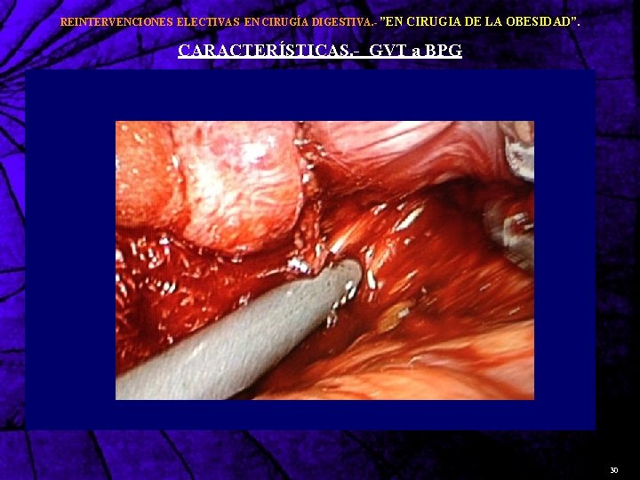 REINTERVENCIONES ELECTIVAS EN CIRUGÍA DIGESTIVA. - ”EN CIRUGIA DE LA OBESIDAD”. CARACTERÍSTICAS. - GVT