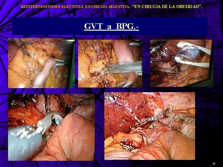 REINTERVENCIONES ELECTIVAS EN CIRUGÍA DIGESTIVA. - ”EN CIRUGIA DE LA OBESIDAD”. GVT a BPG.