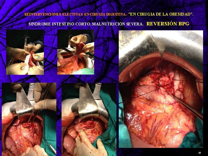 REINTERVENCIONES ELECTIVAS EN CIRUGÍA DIGESTIVA. - ”EN CIRUGIA DE LA OBESIDAD”. SINDROME INTESTINO CORTO.