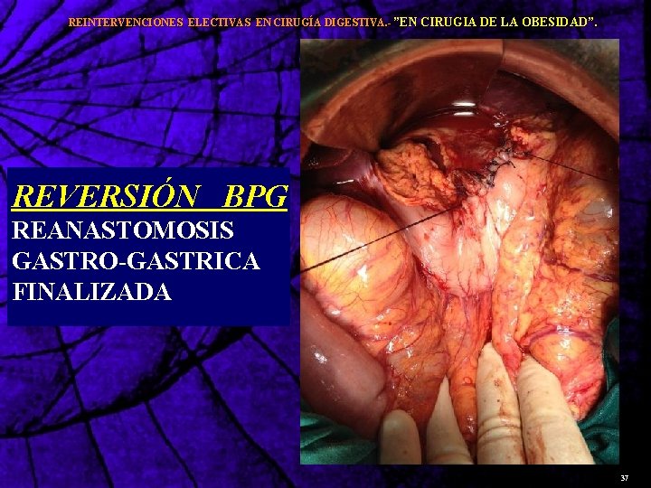 REINTERVENCIONES ELECTIVAS EN CIRUGÍA DIGESTIVA. - ”EN CIRUGIA DE LA OBESIDAD”. REVERSIÓN BPG REANASTOMOSIS