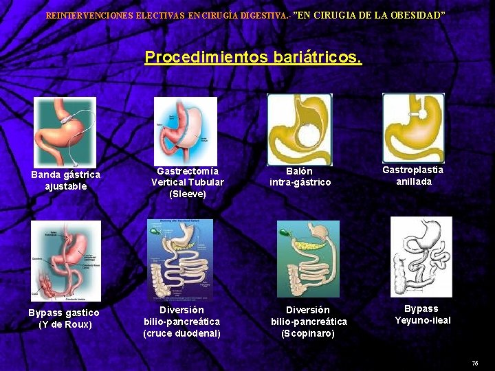 REINTERVENCIONES ELECTIVAS EN CIRUGÍA DIGESTIVA. - ”EN CIRUGIA DE LA OBESIDAD” Procedimientos bariátricos. Banda