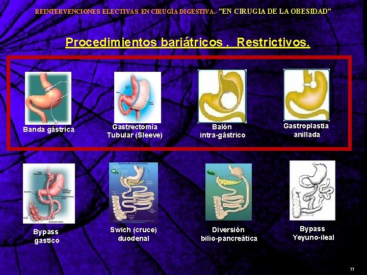 REINTERVENCIONES ELECTIVAS EN CIRUGÍA DIGESTIVA. - ”EN CIRUGIA DE LA OBESIDAD” Procedimientos bariátricos. Restrictivos.